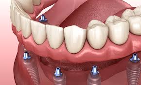 Endodontist noida, prosthodontist Delhi NCR, pedodontist Delhi NCR, Facial Peels Noida, Dental Implants Greater Noida, Teeth Cleaning noida, Dr Neetika, segen clinic
