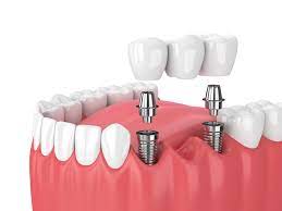 Teeth Whitening Noida, dental crown Noida, RCT Treatment in noida., Dr Neetika, segen clinic